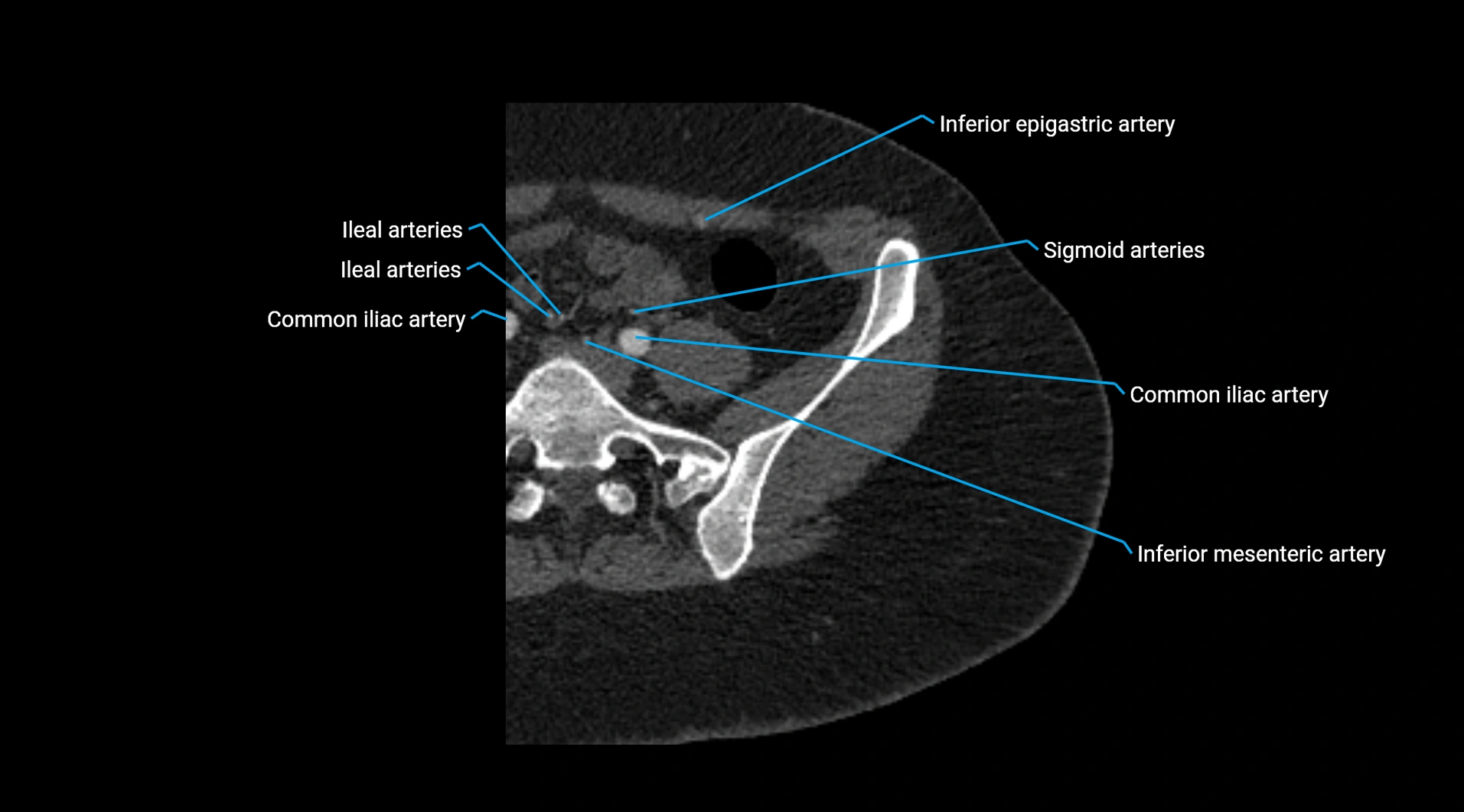 CTA lower limb cross sectional anatomy labelled image _15.webp